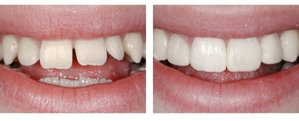 Реставрация зубов - Стоматология Дентал